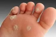 دلیل میخچه زدن پا چیست؟ + راهکارهای درمانی