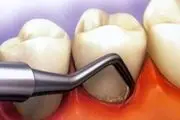 عوارض کشیدن زودرس دندان شیری

