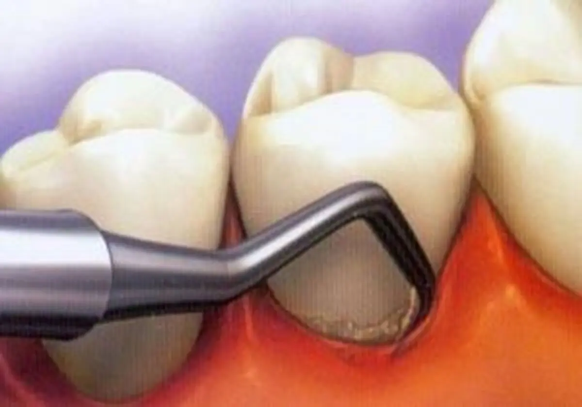 5 عادت مخرب برای دندان‌های شما
