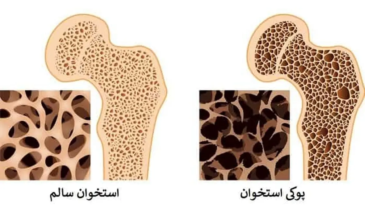 خطرات استفاده بیرویه از مصرف نمک