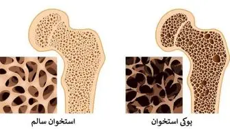 پوکی استخوان سراغ چه کسانی می‌رود؟