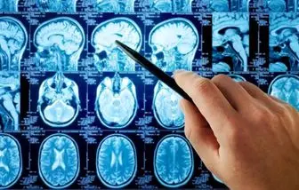 آنچه در مورد علائم و درمان تومورهای مغزی باید بدانید