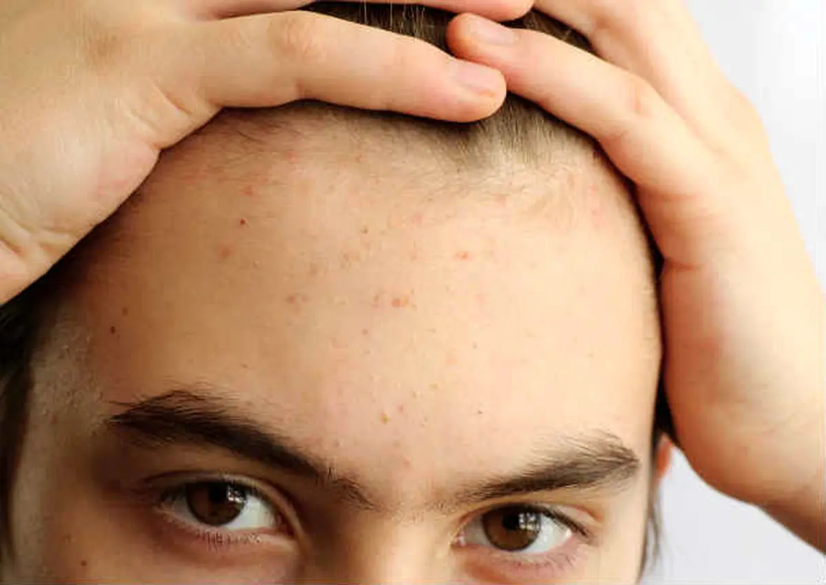 چگونه جوشهای روی پیشانی را درمان کنیم؟