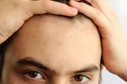 راه حل هایی برای درمان قطعی جوش های روی پیشانی