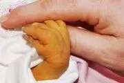 هشدار! حجامت نوزاد برای درمان زردی عوارض مرگبار دارد