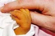 هشدار! حجامت نوزاد برای درمان زردی عوارض مرگبار دارد