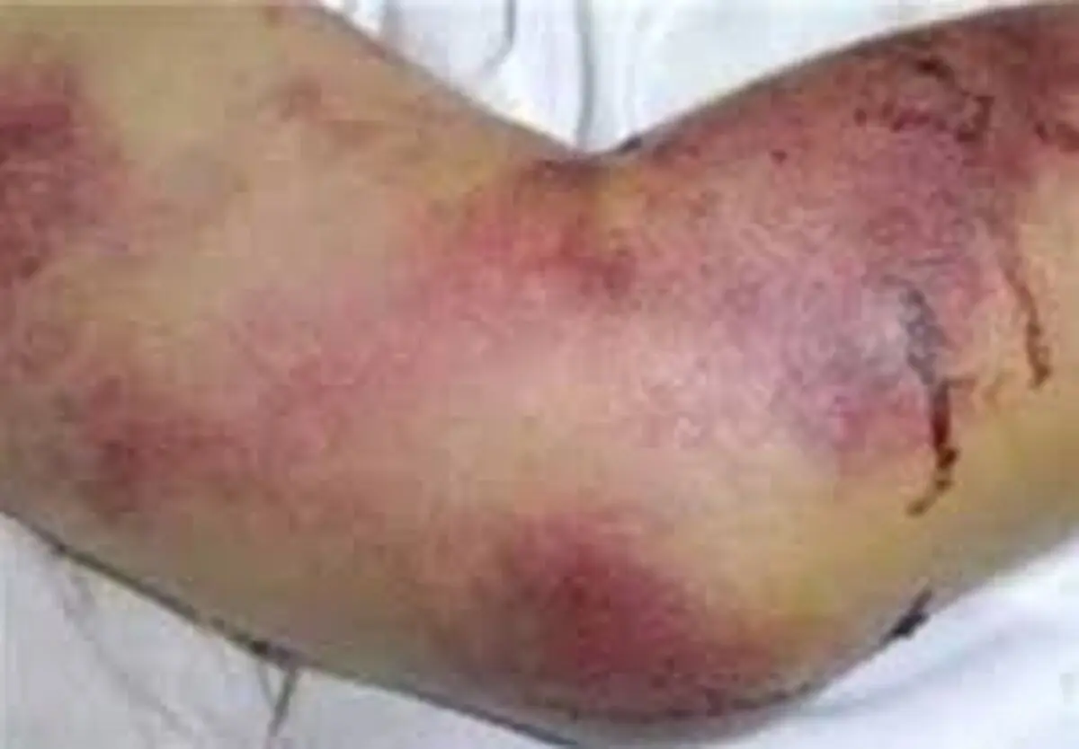 هشدار؛ ابتلای دوباره هم وطنان به تب کنگو