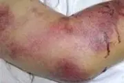 ابتلای ۵۴ نفر در کشور به تب کریمه کنگو