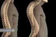 گوژپشتی علل و درمان