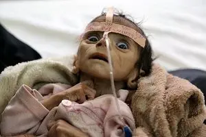 خطر مرگ برای ۴۰۰ هزار کودک یمنی زیر ۵ سال