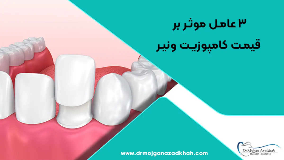 3 عامل موثر بر قیمت کامپوزیت ونیر
