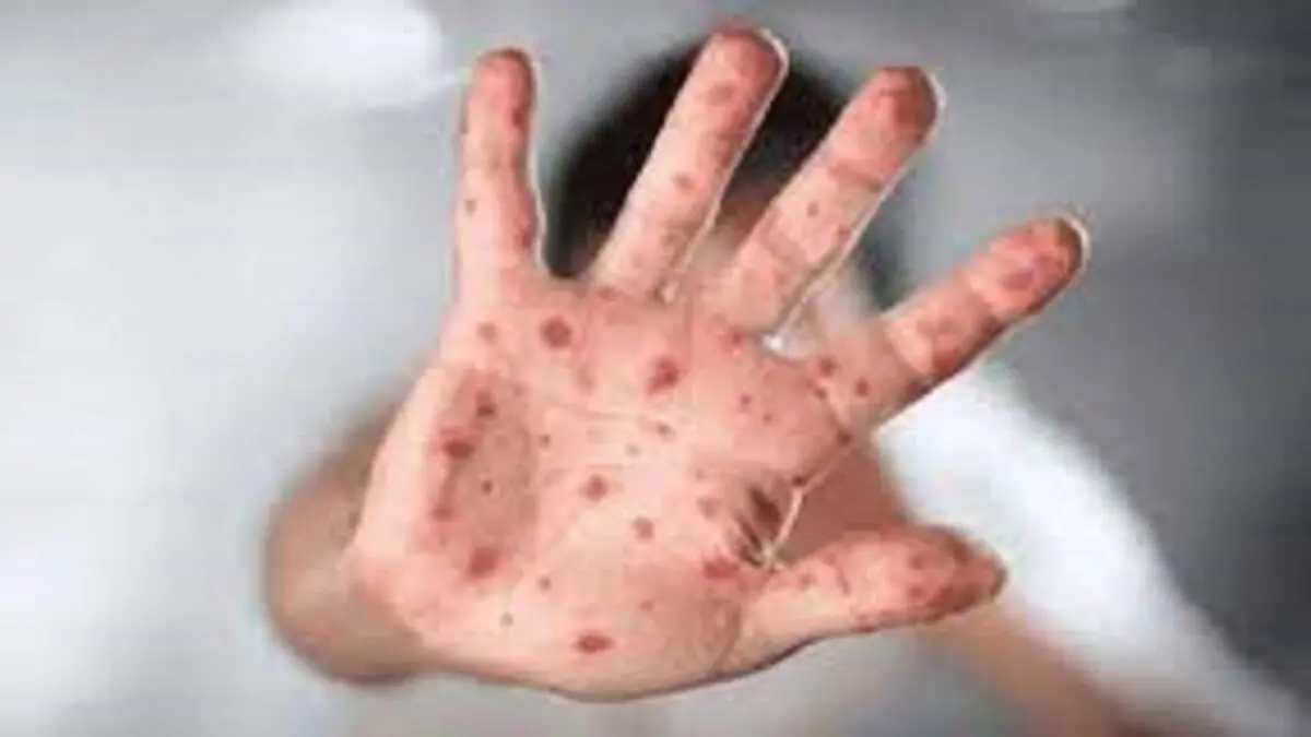 افراد دارای سیستم ایمنی ضعیف در معرض ابتلا به آبله میمونی
