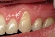 علت باد کردن لثه دندان