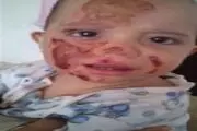 حال و روز خانواده بجنوردی که در انفجار اجاق گاز سوختند
