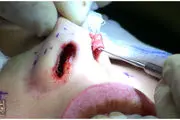 عوارض جراحی بینی چیست؟
