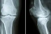 چه کسانی باید تست تراکم استخوان بدهند؟