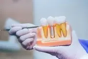 
پاسخ به سؤالات رایج در مورد ایمپلنت