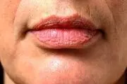 لب‌های شما از وضعیت سلامت‌تان می‌گویند!