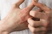 این بیماری‌ با اضطراب شدیدتر می‌شود