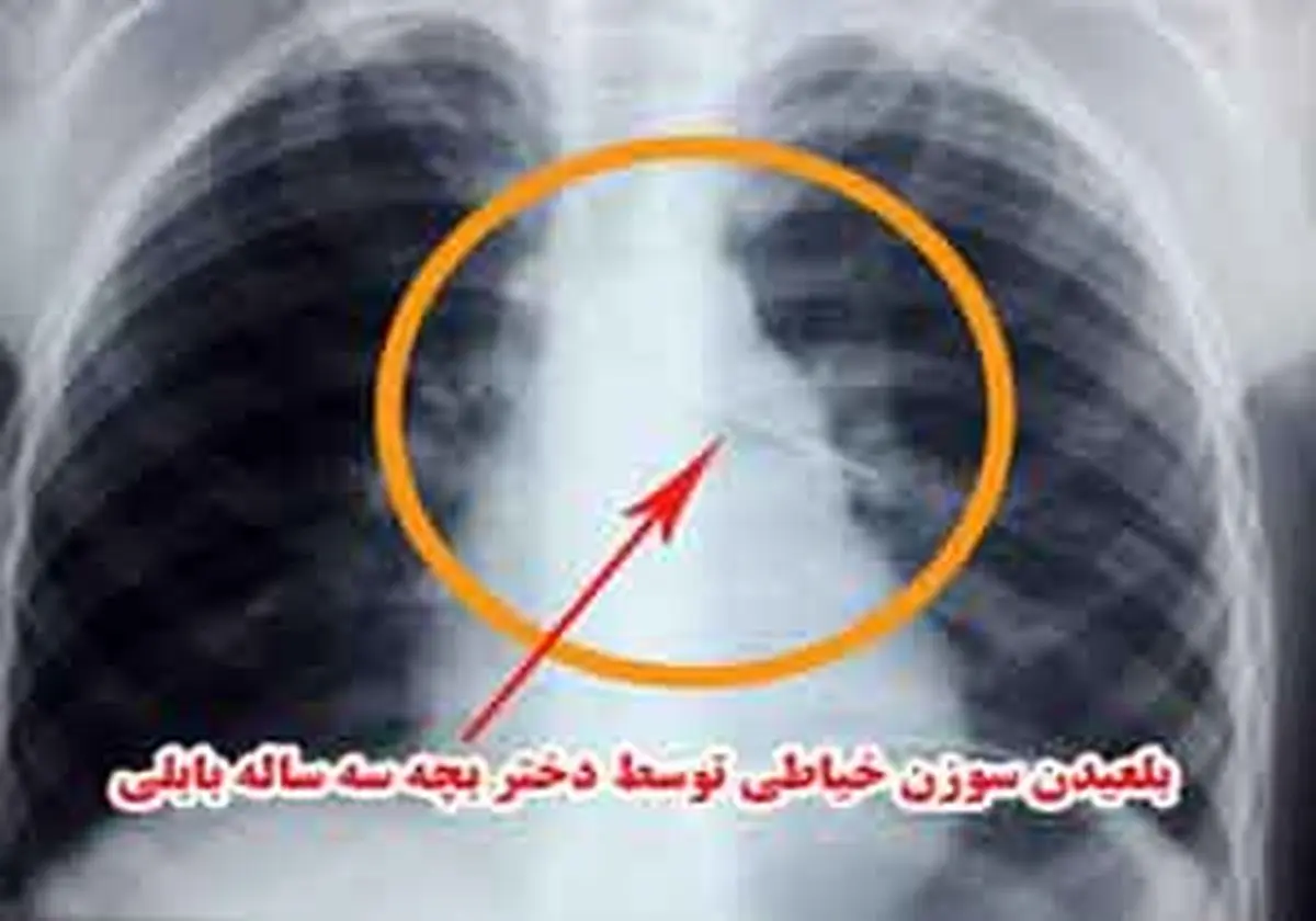 سوزن خیاطی در نای دختر بچه بابلی