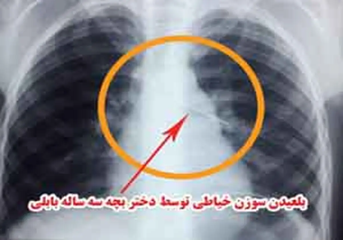 
سوزن خیاطی در نای دختر بچه بابلی
