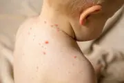 هشدار جدی درباره شیوع یک بیماری ویروسی در کودکان