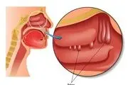پولیپ چیست و درمان آن چگونه است؟