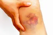 علت کبودی پوست+درمان