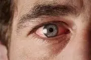 چشم‌ها هم دچار آفتاب‌سوختگی می‌شوند

