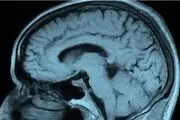 گردنبندی که از ضربه مغزی جلوگیری می کند