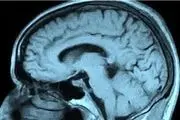 از کجا بفهمیم تومور مغزی داریم؟