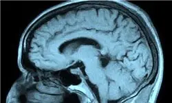 نشانه‌های ابتلا به تومورهای مغزی