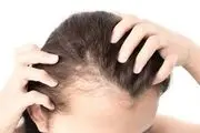 
طاسی الگوی زنانه و راههای درمان آن

