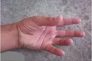 دلایل خواب رفتن دست و پا + اینفوگرافیک
