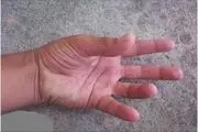 دلایل خواب رفتن دست و پا + اینفوگرافیک
