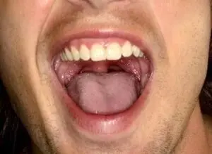 راهکار طلایی برای درمان خشکی دهان