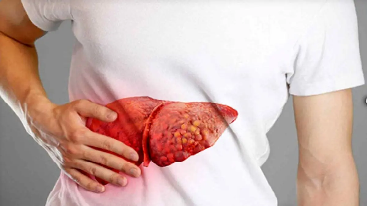 ابتلای یک سوم از مردم به عارضه کبد چرب
