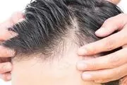 آیا سفید شدن مو قابل درمان است؟