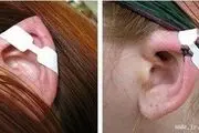 افزایش متقاضیان برای عمل زیبایی گوش