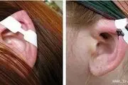 افزایش متقاضیان برای عمل زیبایی گوش