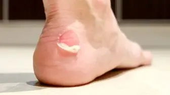 چرا تاول روی پا دردناک است؟
