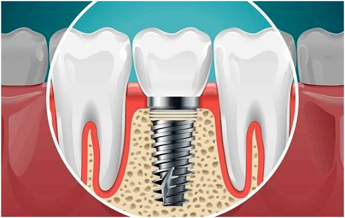 علائم پس زدن ایمپلنت