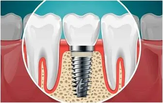 علائم پس زدن ایمپلنت 