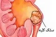 راهکارهای خانگی برای دفع سنگ کلیه /  اینفوگرافیک