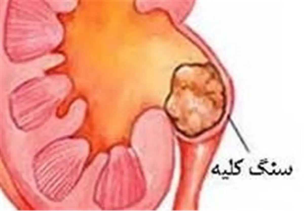 چرا کودکان و نوزادان سنگ کلیه می گیرند؟