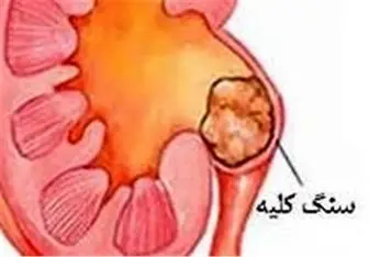 سنگ کلیه چگونه ایجاد می‌شوند؟