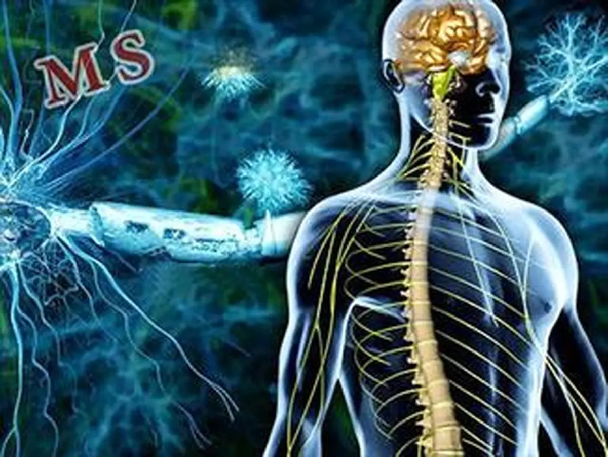 تاثیر ویتامین D در کاهش ریسک ابتلا به ام اس