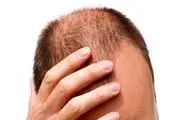 درمان ریزش مو بعد از کرونا