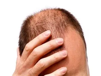 ریزش طبیعی موی سر در روز چقدر است؟