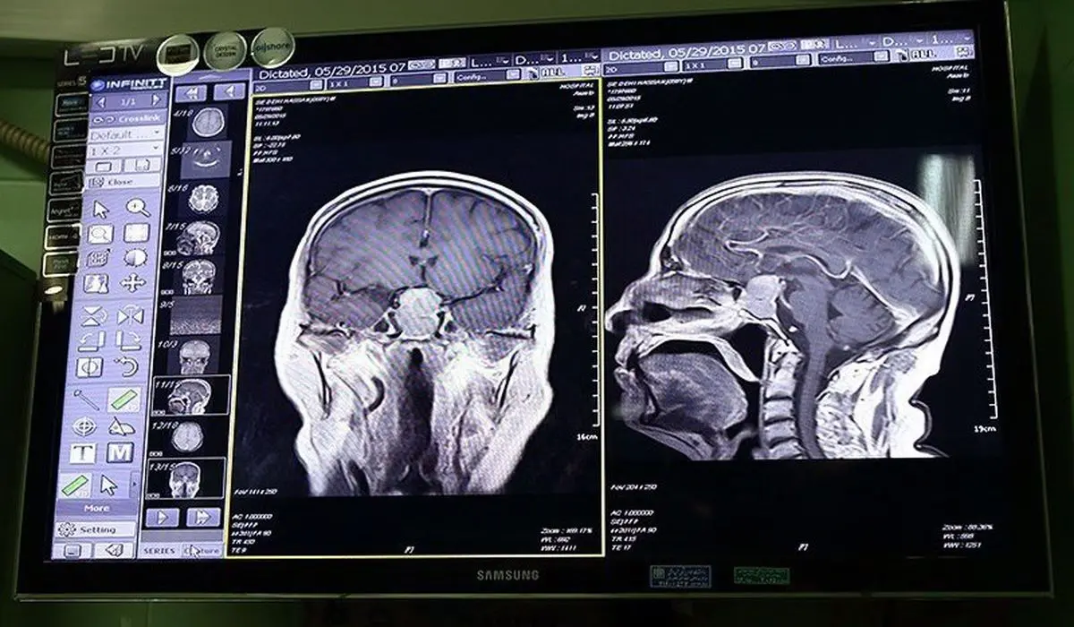 نگهدارنده فلپ جمجمه با ویژگیهای خاص در ایران تولید شد
